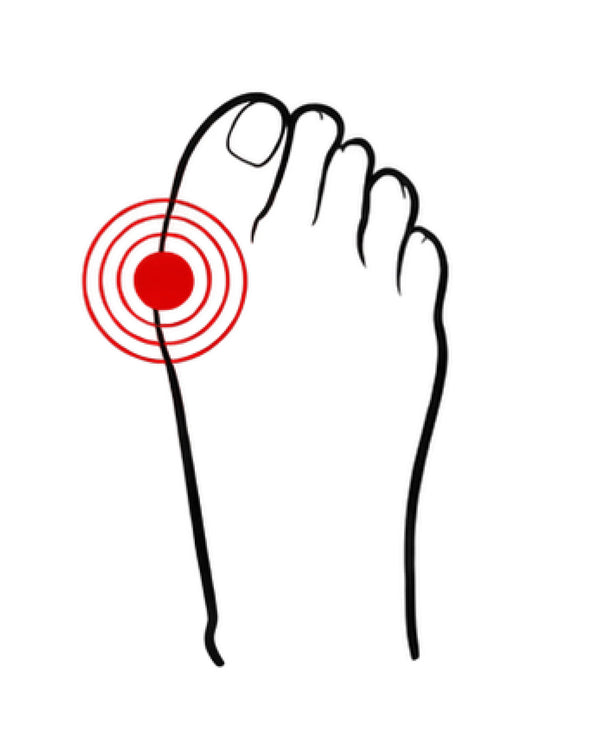 Orthotics For   Bunions