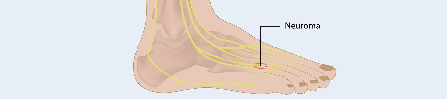 Morton Neuroma