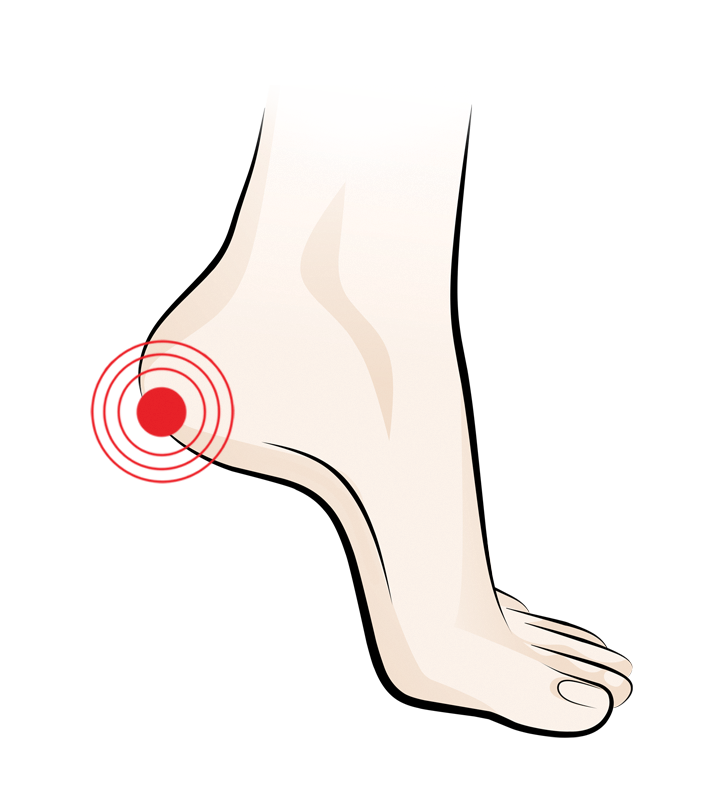 Plantar Fasciitis Heel Spur