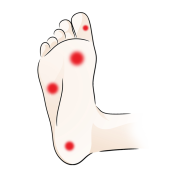 Diabetic Foot