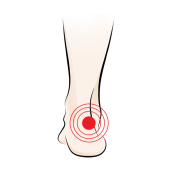 Achilles Tendonitis