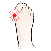 Halux Valgus Bunion