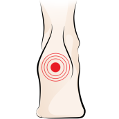 Heel Pain