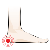 Heel Spur