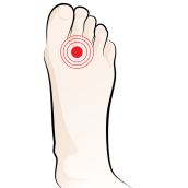 Mortons Neuroma