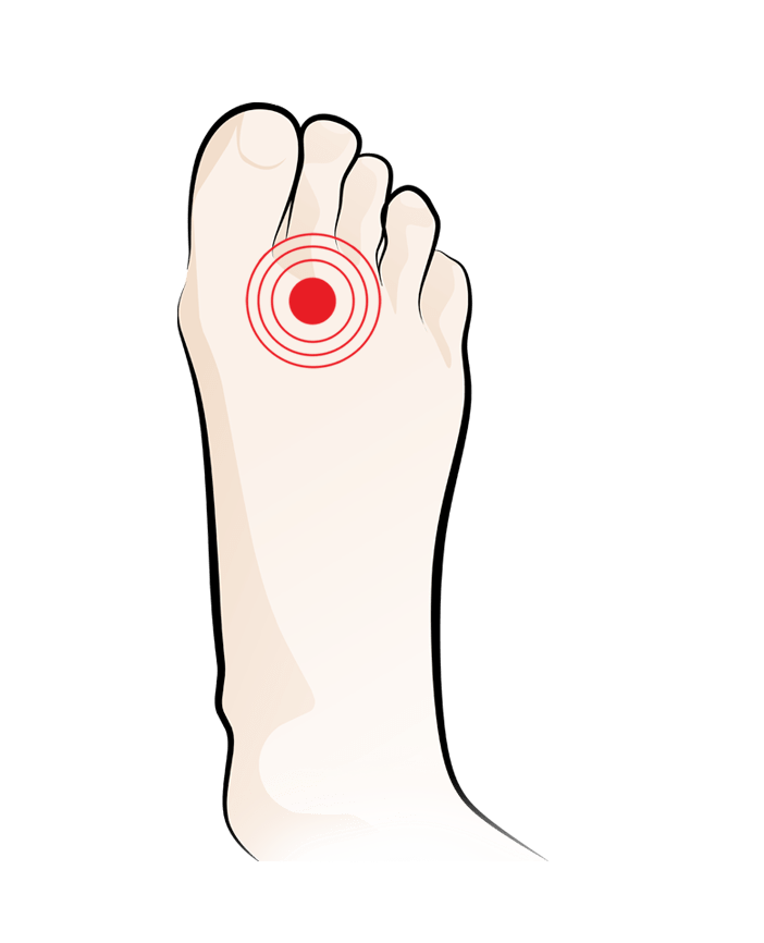 Mortons Neuroma